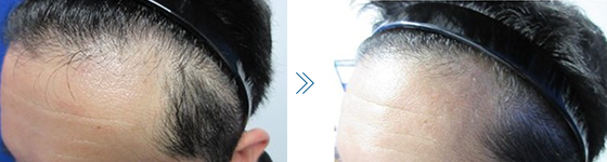 写真：39歳男性 皮脂の分泌が少なくなり髪質、肌質も改善 Before After